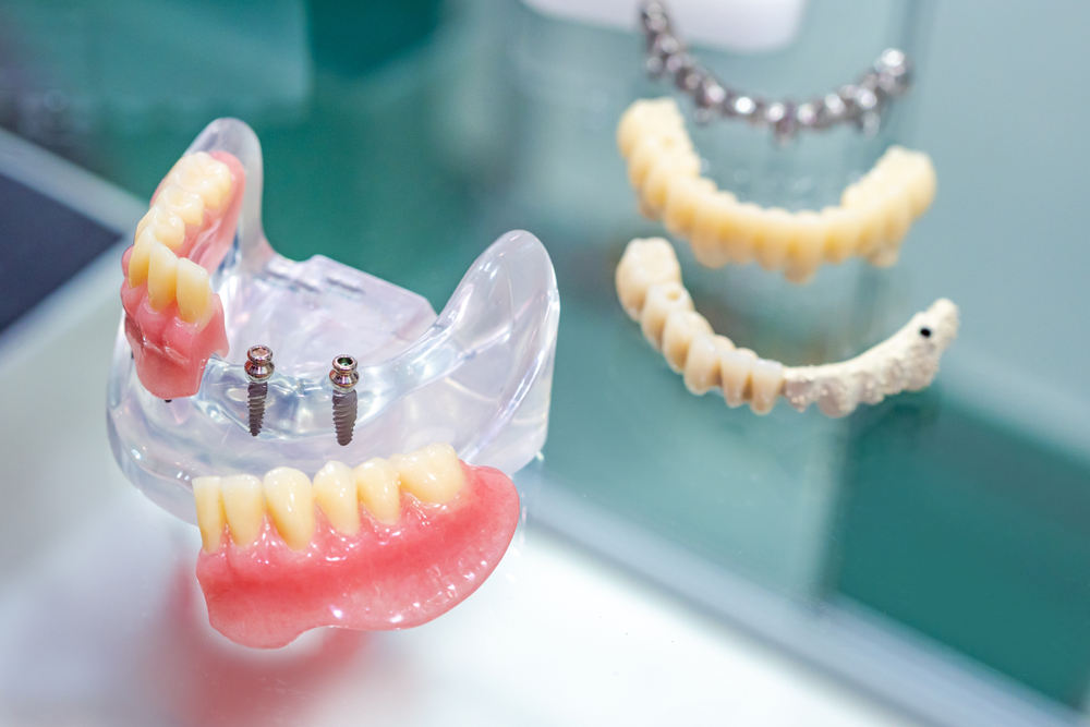 Premier Dentistry. | Which Dental Implant is Right For You? Premier Dentistry. | Which Dental Implant is Right For You?